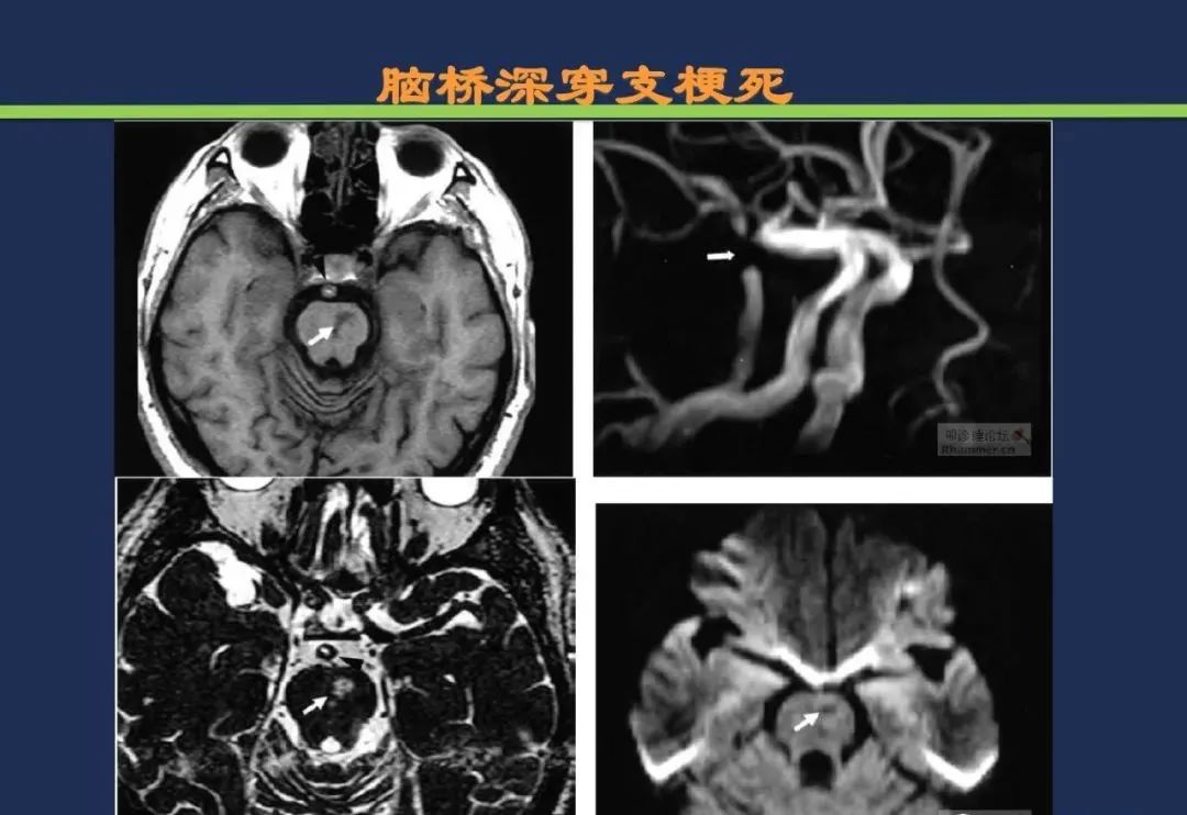 影像PPT - 从梗死部位推测责任血管:脑血管解剖-131 影像PPT - 从梗死部位推测责任血管:脑血管解剖-131