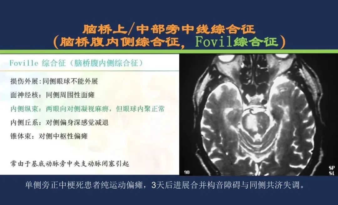 影像PPT - 从梗死部位推测责任血管:脑血管解剖-133 影像PPT - 从梗死部位推测责任血管:脑血管解剖-133