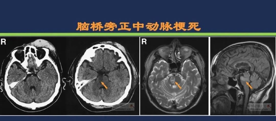 影像PPT - 从梗死部位推测责任血管:脑血管解剖-134 影像PPT - 从梗死部位推测责任血管:脑血管解剖-134