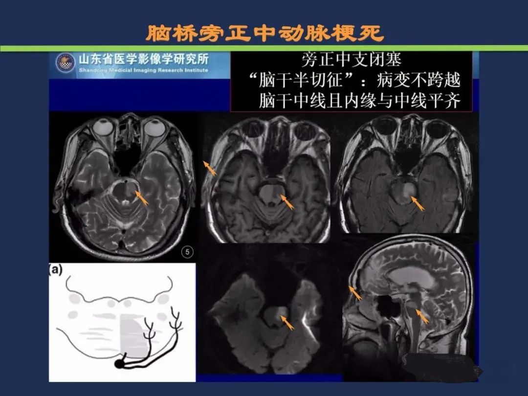 影像PPT - 从梗死部位推测责任血管:脑血管解剖-135 影像PPT - 从梗死部位推测责任血管:脑血管解剖-135