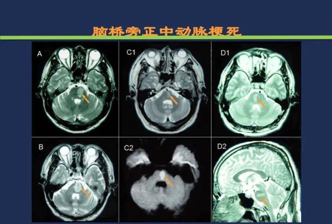 影像PPT - 从梗死部位推测责任血管:脑血管解剖-136 影像PPT - 从梗死部位推测责任血管:脑血管解剖-136
