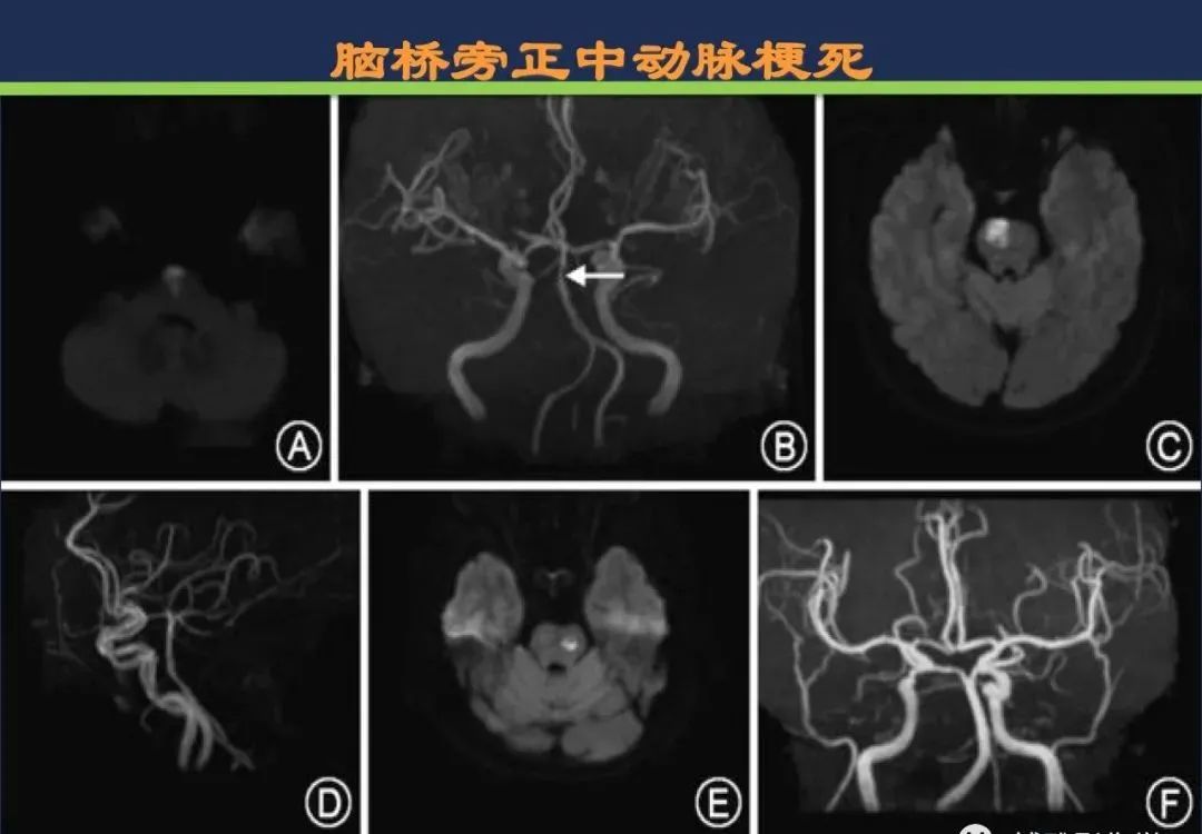 影像PPT - 从梗死部位推测责任血管:脑血管解剖-137 影像PPT - 从梗死部位推测责任血管:脑血管解剖-137