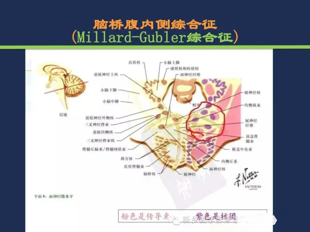 影像PPT - 从梗死部位推测责任血管:脑血管解剖-138 影像PPT - 从梗死部位推测责任血管:脑血管解剖-138