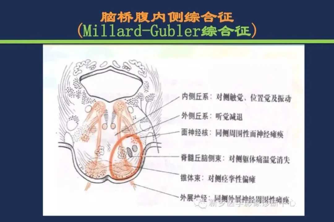 影像PPT - 从梗死部位推测责任血管:脑血管解剖-139 影像PPT - 从梗死部位推测责任血管:脑血管解剖-139