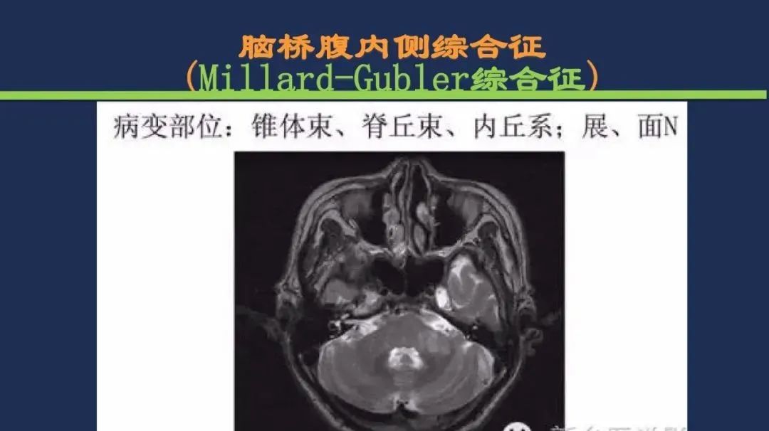 影像PPT - 从梗死部位推测责任血管:脑血管解剖-140 影像PPT - 从梗死部位推测责任血管:脑血管解剖-140