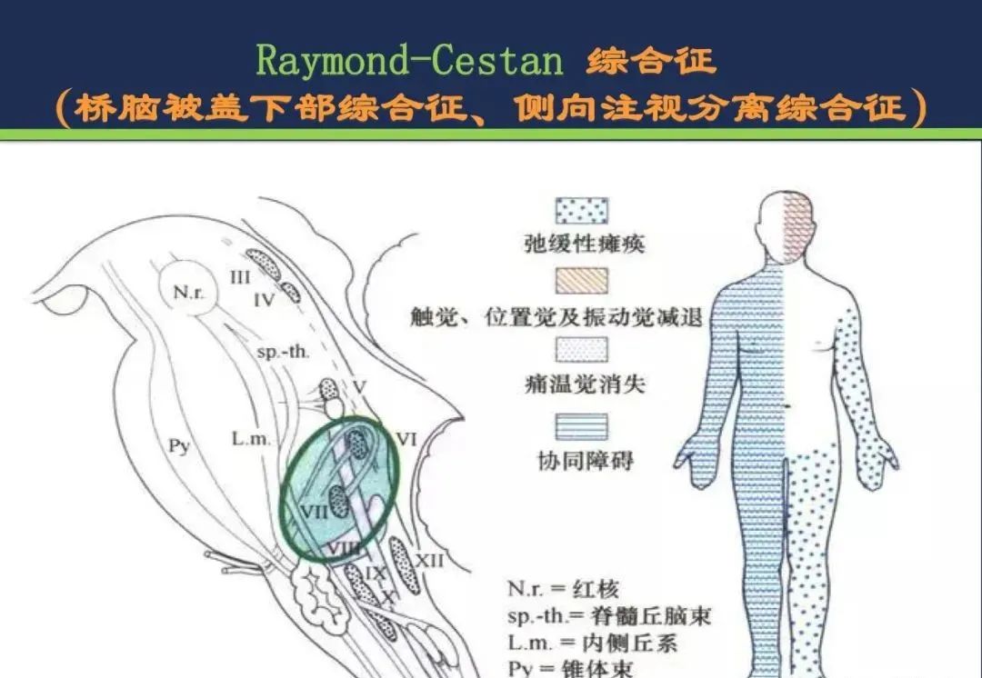影像PPT - 从梗死部位推测责任血管:脑血管解剖-141 影像PPT - 从梗死部位推测责任血管:脑血管解剖-141