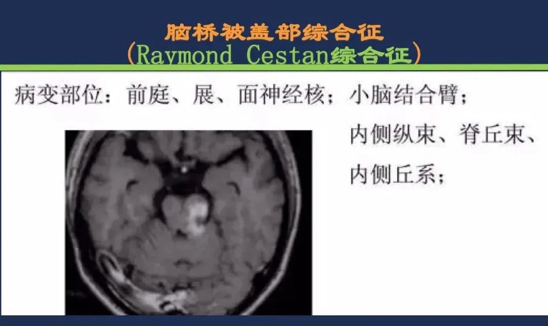 影像PPT - 从梗死部位推测责任血管:脑血管解剖-143 影像PPT - 从梗死部位推测责任血管:脑血管解剖-143