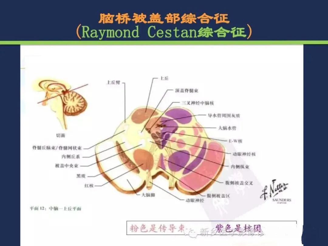 影像PPT - 从梗死部位推测责任血管:脑血管解剖-144 影像PPT - 从梗死部位推测责任血管:脑血管解剖-144