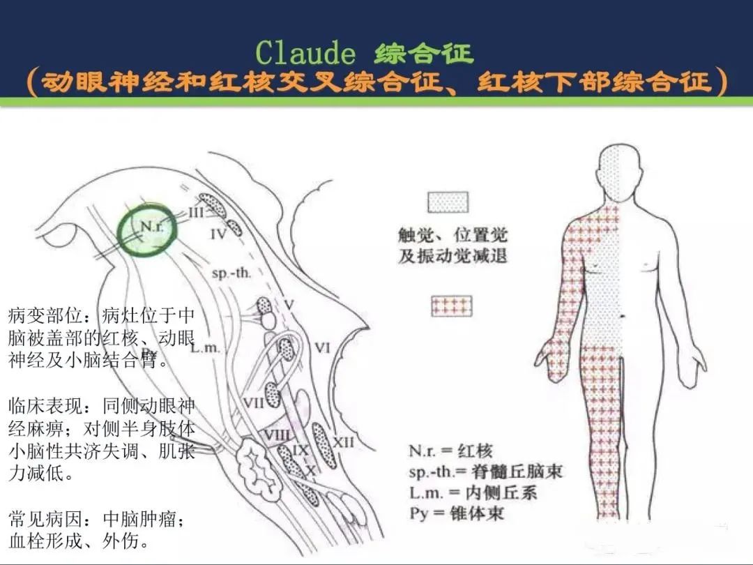 影像PPT - 从梗死部位推测责任血管:脑血管解剖-147 影像PPT - 从梗死部位推测责任血管:脑血管解剖-147