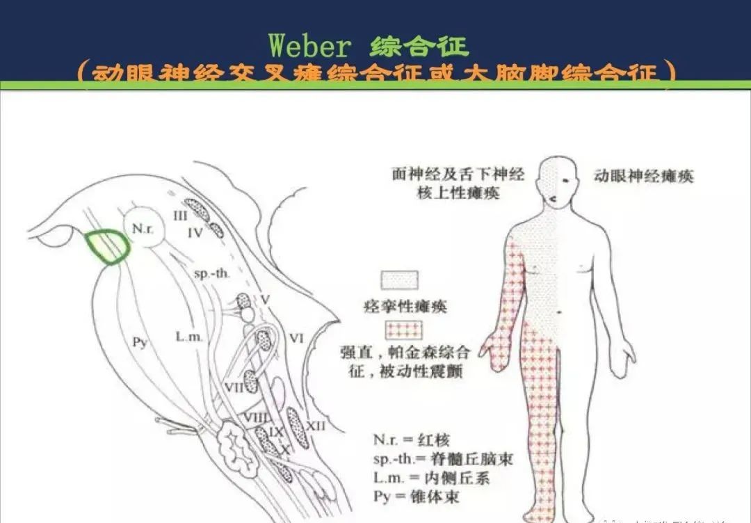 影像PPT - 从梗死部位推测责任血管:脑血管解剖-149 影像PPT - 从梗死部位推测责任血管:脑血管解剖-149