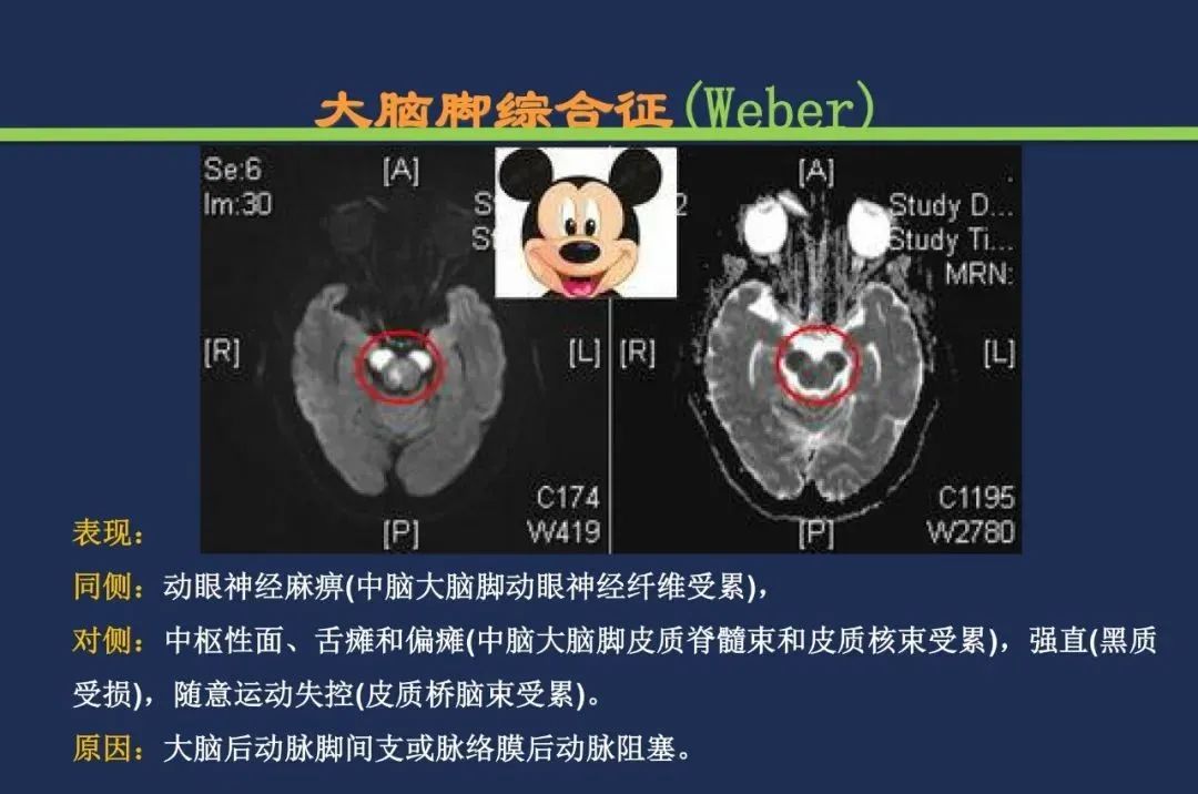 影像PPT - 从梗死部位推测责任血管:脑血管解剖-150 影像PPT - 从梗死部位推测责任血管:脑血管解剖-150