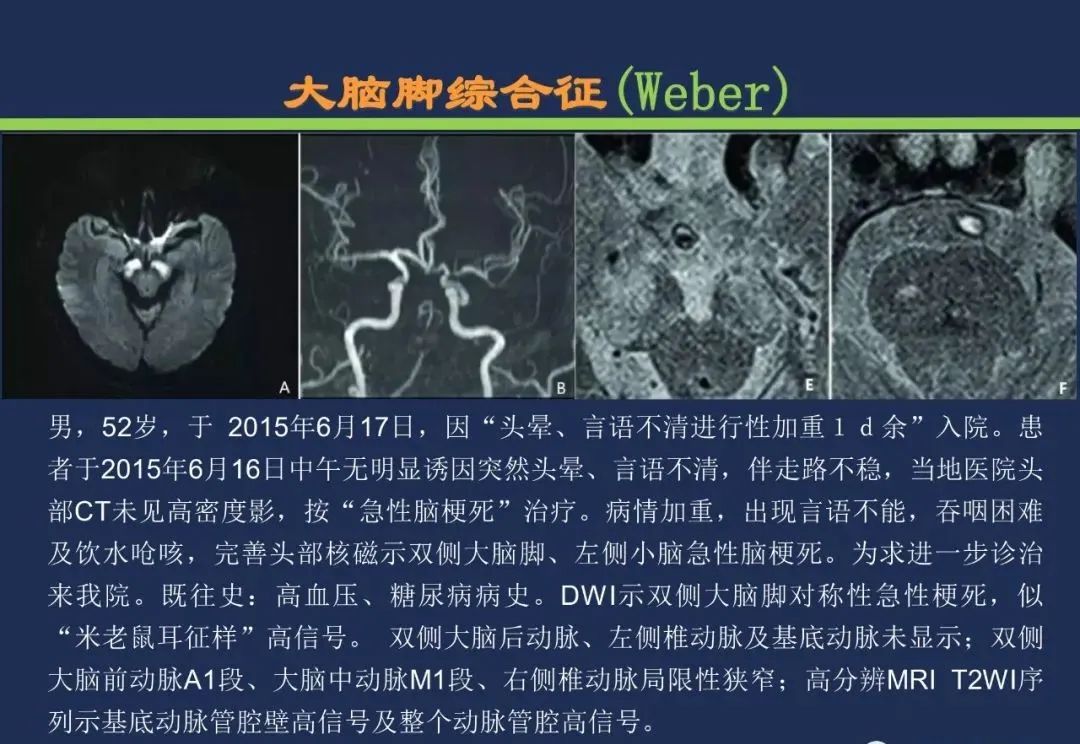 影像PPT - 从梗死部位推测责任血管:脑血管解剖-151 影像PPT - 从梗死部位推测责任血管:脑血管解剖-151
