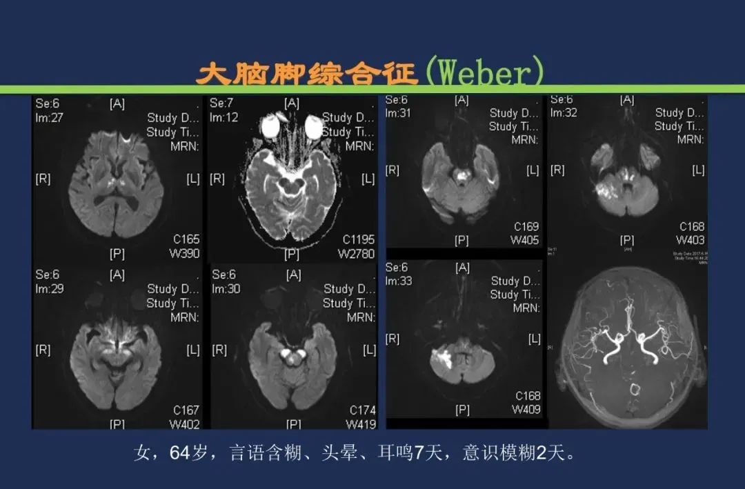 影像PPT - 从梗死部位推测责任血管:脑血管解剖-152 影像PPT - 从梗死部位推测责任血管:脑血管解剖-152