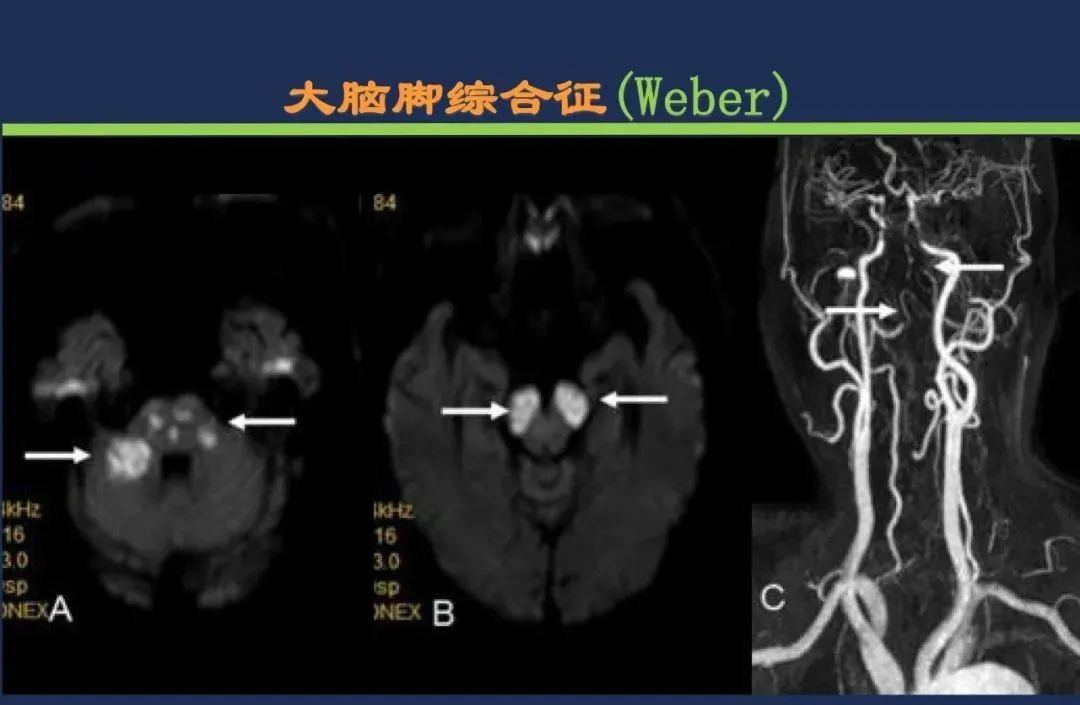 影像PPT - 从梗死部位推测责任血管:脑血管解剖-153 影像PPT - 从梗死部位推测责任血管:脑血管解剖-153
