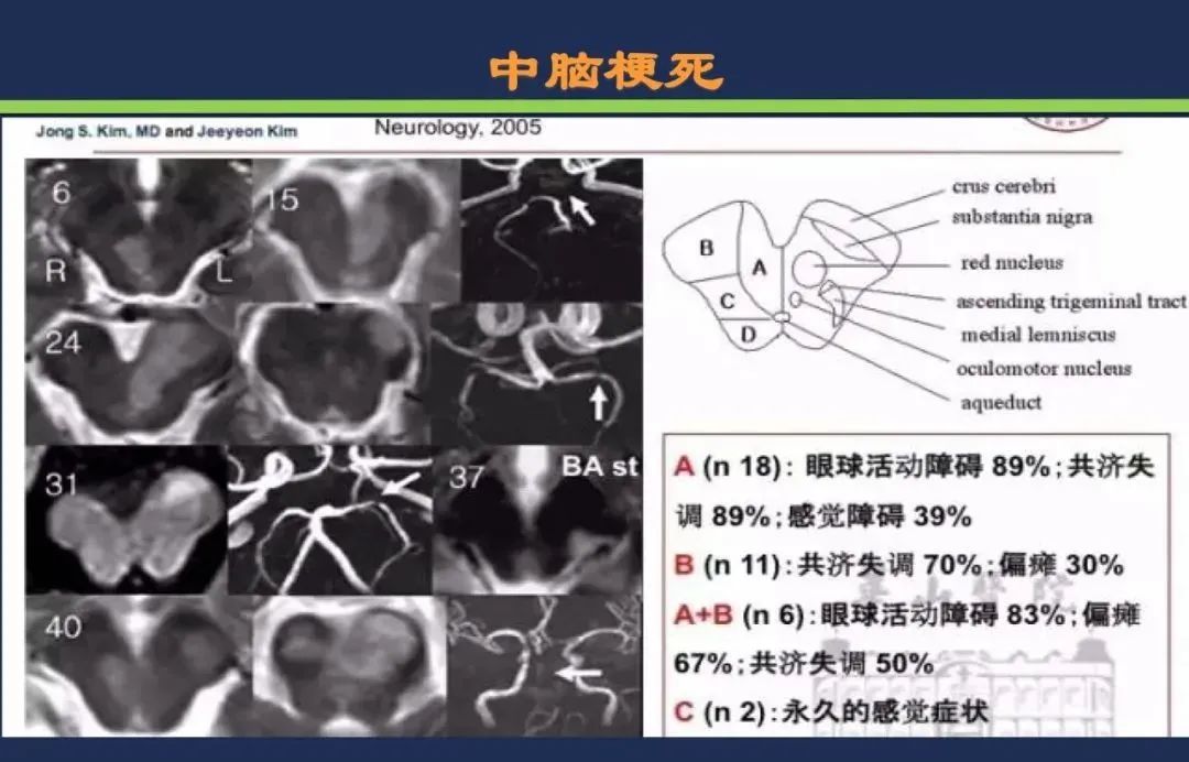 影像PPT - 从梗死部位推测责任血管:脑血管解剖-155 影像PPT - 从梗死部位推测责任血管:脑血管解剖-155
