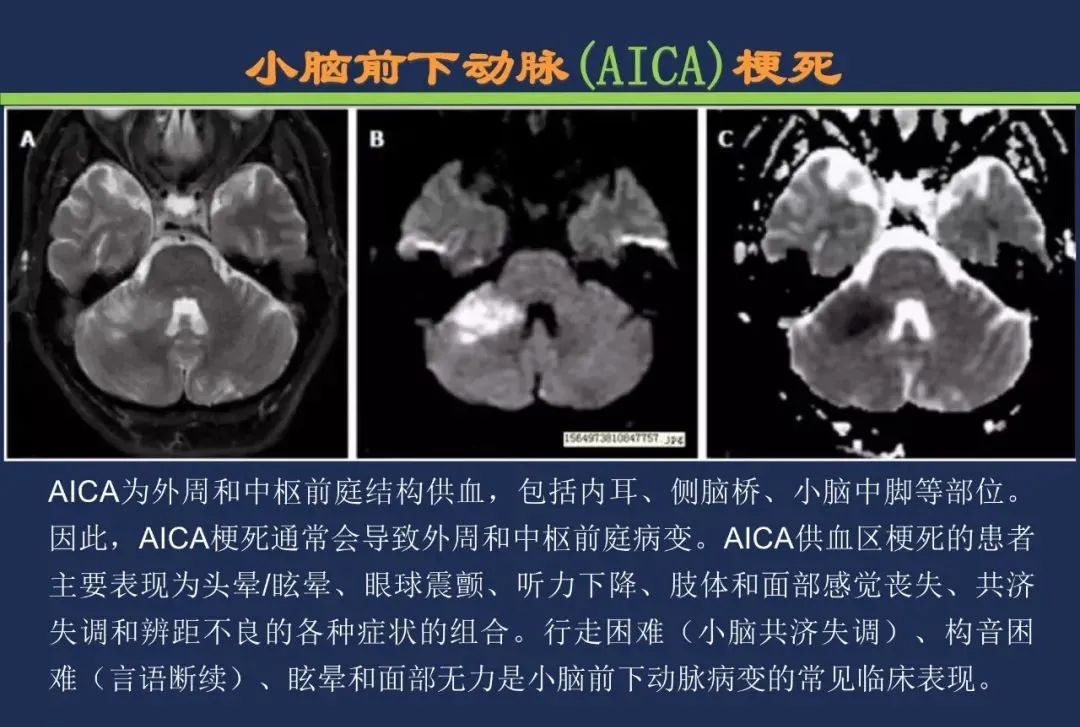 影像PPT - 从梗死部位推测责任血管:脑血管解剖-156 影像PPT - 从梗死部位推测责任血管:脑血管解剖-156