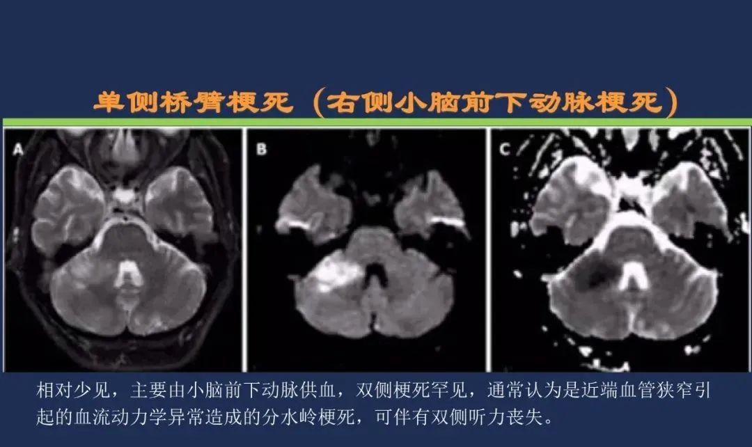 影像PPT - 从梗死部位推测责任血管:脑血管解剖-157 影像PPT - 从梗死部位推测责任血管:脑血管解剖-157