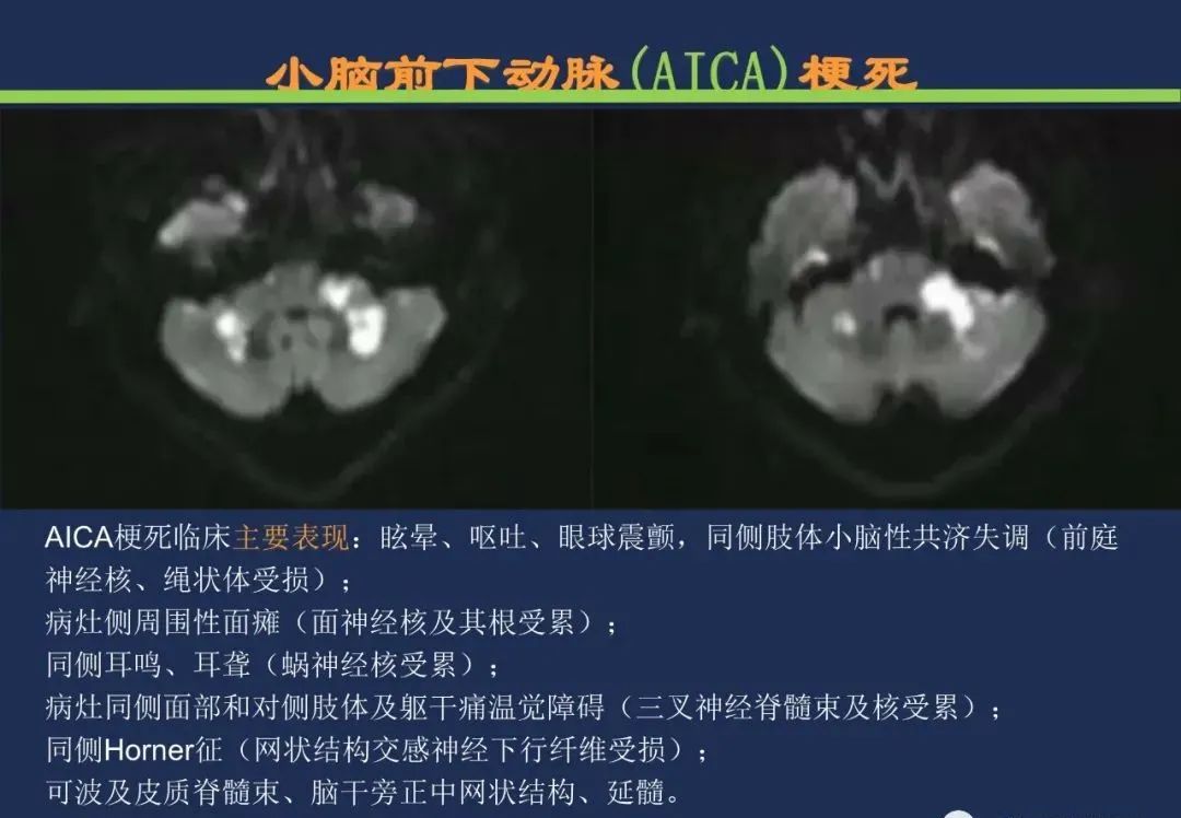 影像PPT - 从梗死部位推测责任血管:脑血管解剖-158 影像PPT - 从梗死部位推测责任血管:脑血管解剖-158