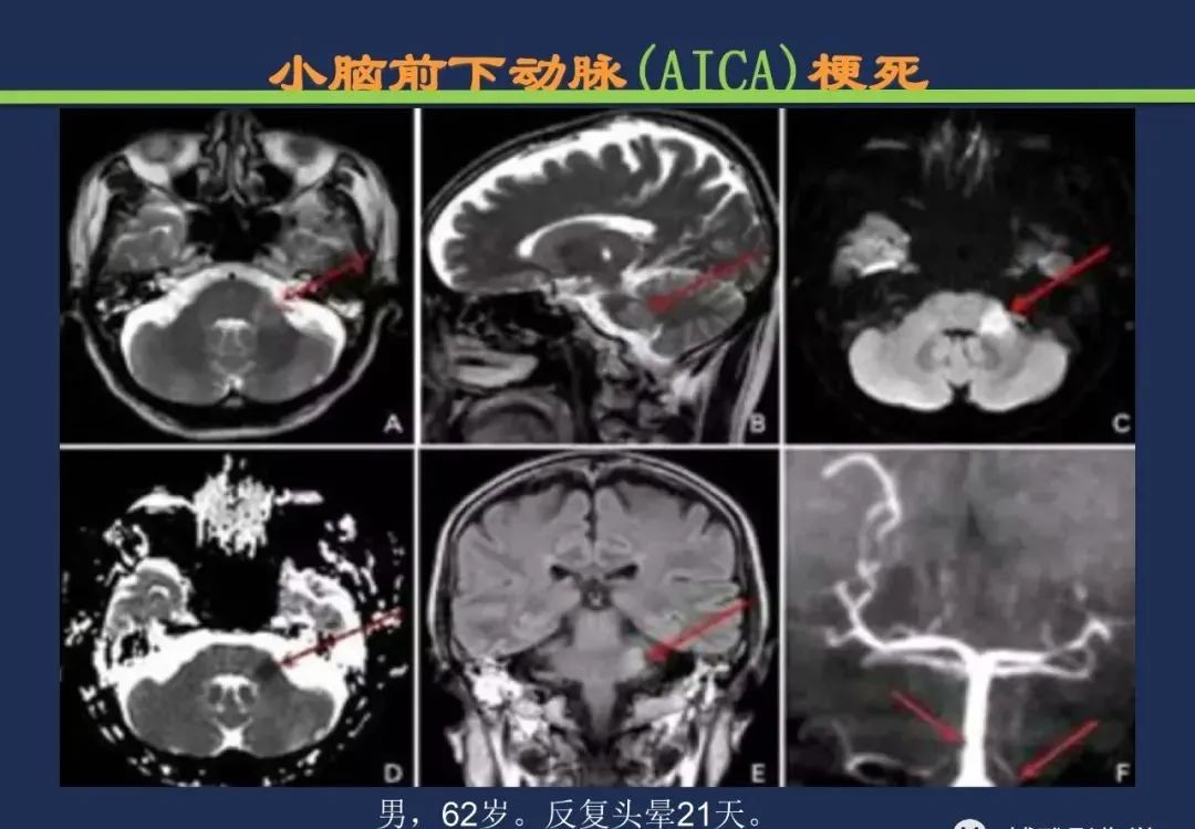 影像PPT - 从梗死部位推测责任血管:脑血管解剖-159 影像PPT - 从梗死部位推测责任血管:脑血管解剖-159