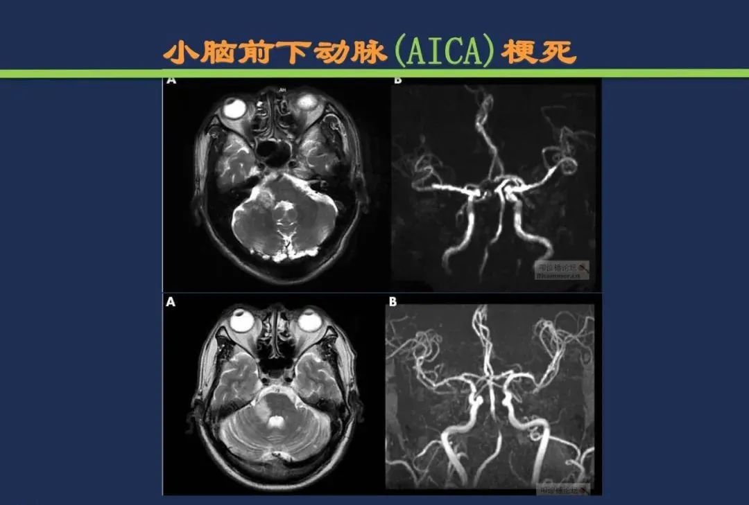 影像PPT - 从梗死部位推测责任血管:脑血管解剖-160 影像PPT - 从梗死部位推测责任血管:脑血管解剖-160