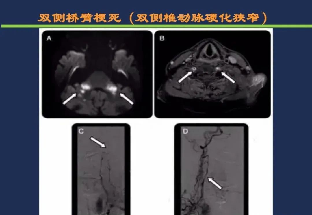 影像PPT - 从梗死部位推测责任血管:脑血管解剖-161 影像PPT - 从梗死部位推测责任血管:脑血管解剖-161