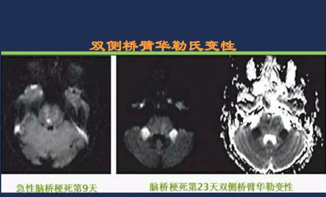 影像PPT - 从梗死部位推测责任血管:脑血管解剖-162 影像PPT - 从梗死部位推测责任血管:脑血管解剖-162