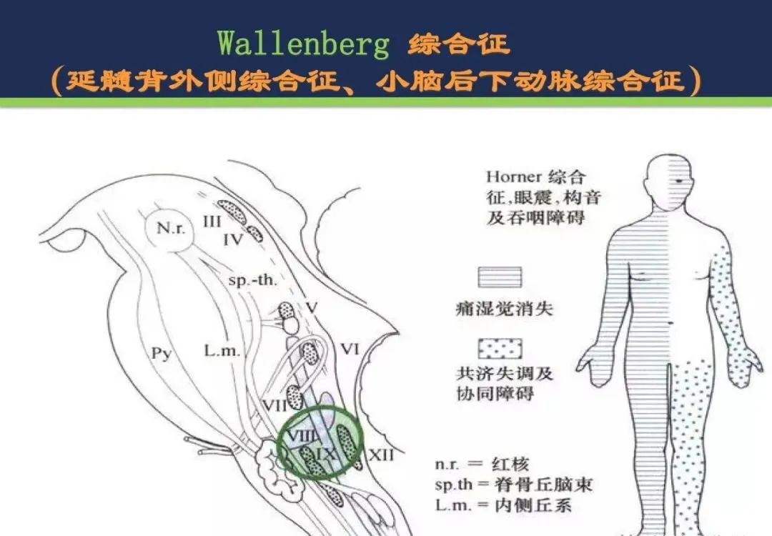 影像PPT - 从梗死部位推测责任血管:脑血管解剖-163 影像PPT - 从梗死部位推测责任血管:脑血管解剖-163