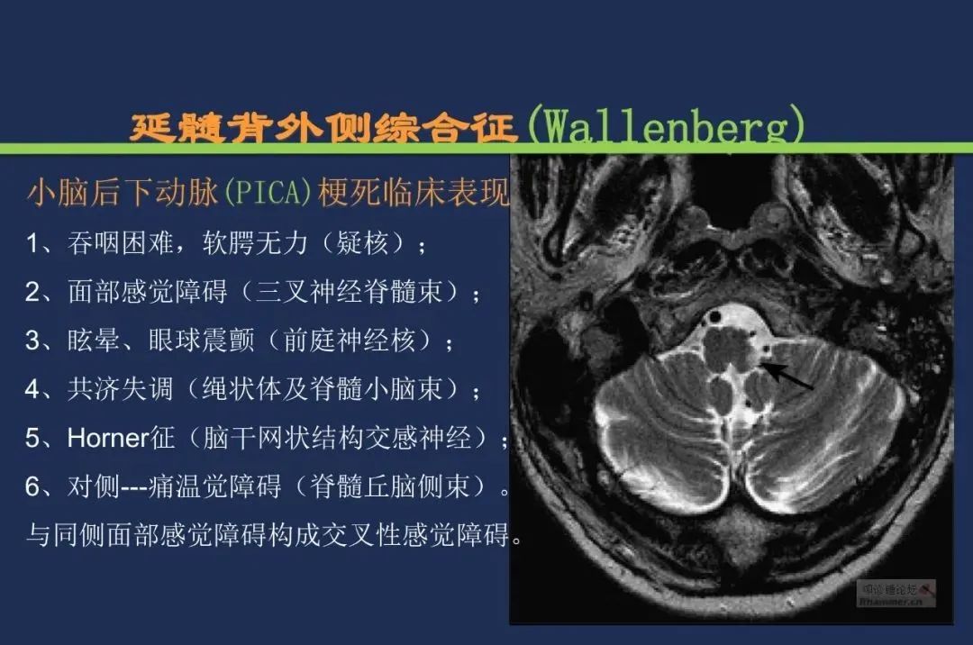 影像PPT - 从梗死部位推测责任血管:脑血管解剖-164 影像PPT - 从梗死部位推测责任血管:脑血管解剖-164