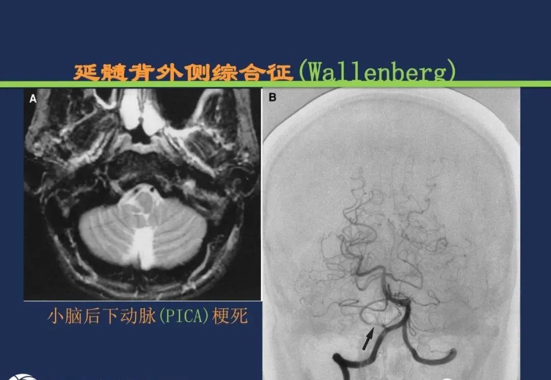 影像PPT - 从梗死部位推测责任血管:脑血管解剖-165 影像PPT - 从梗死部位推测责任血管:脑血管解剖-165
