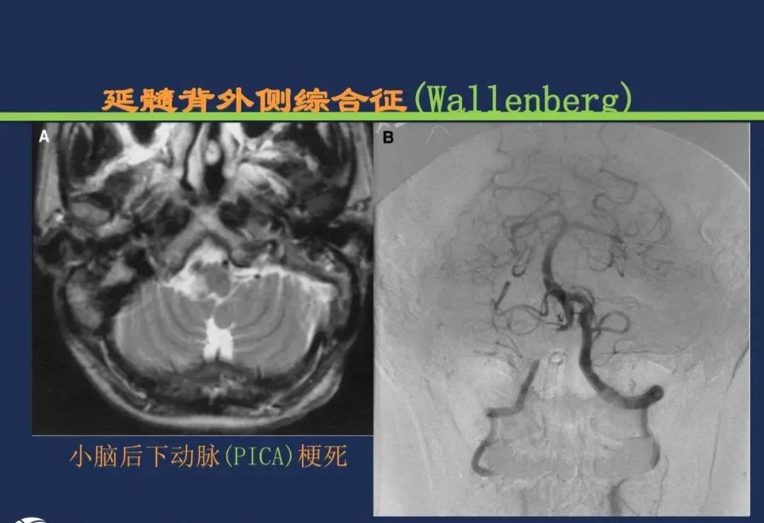 影像PPT - 从梗死部位推测责任血管:脑血管解剖-166 影像PPT - 从梗死部位推测责任血管:脑血管解剖-166