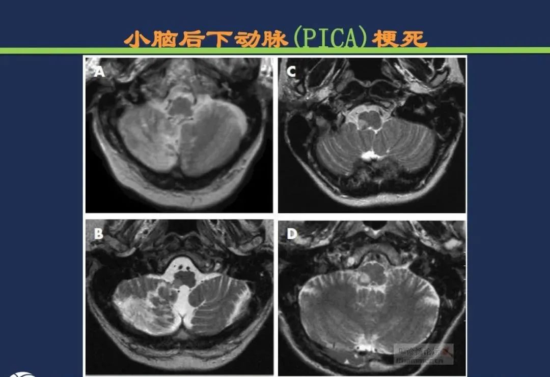 影像PPT - 从梗死部位推测责任血管:脑血管解剖-167 影像PPT - 从梗死部位推测责任血管:脑血管解剖-167