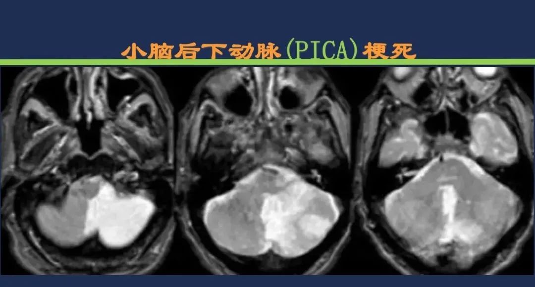 影像PPT - 从梗死部位推测责任血管:脑血管解剖-168 影像PPT - 从梗死部位推测责任血管:脑血管解剖-168