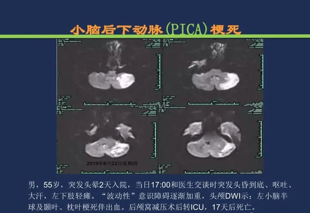 影像PPT - 从梗死部位推测责任血管:脑血管解剖-169 影像PPT - 从梗死部位推测责任血管:脑血管解剖-169