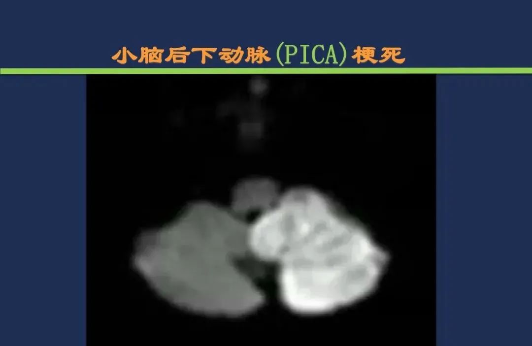 影像PPT - 从梗死部位推测责任血管:脑血管解剖-170 影像PPT - 从梗死部位推测责任血管:脑血管解剖-170