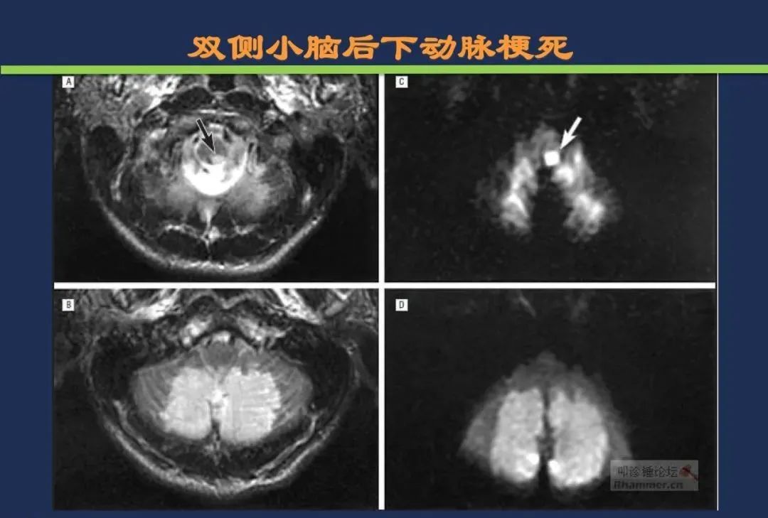 影像PPT - 从梗死部位推测责任血管:脑血管解剖-171 影像PPT - 从梗死部位推测责任血管:脑血管解剖-171