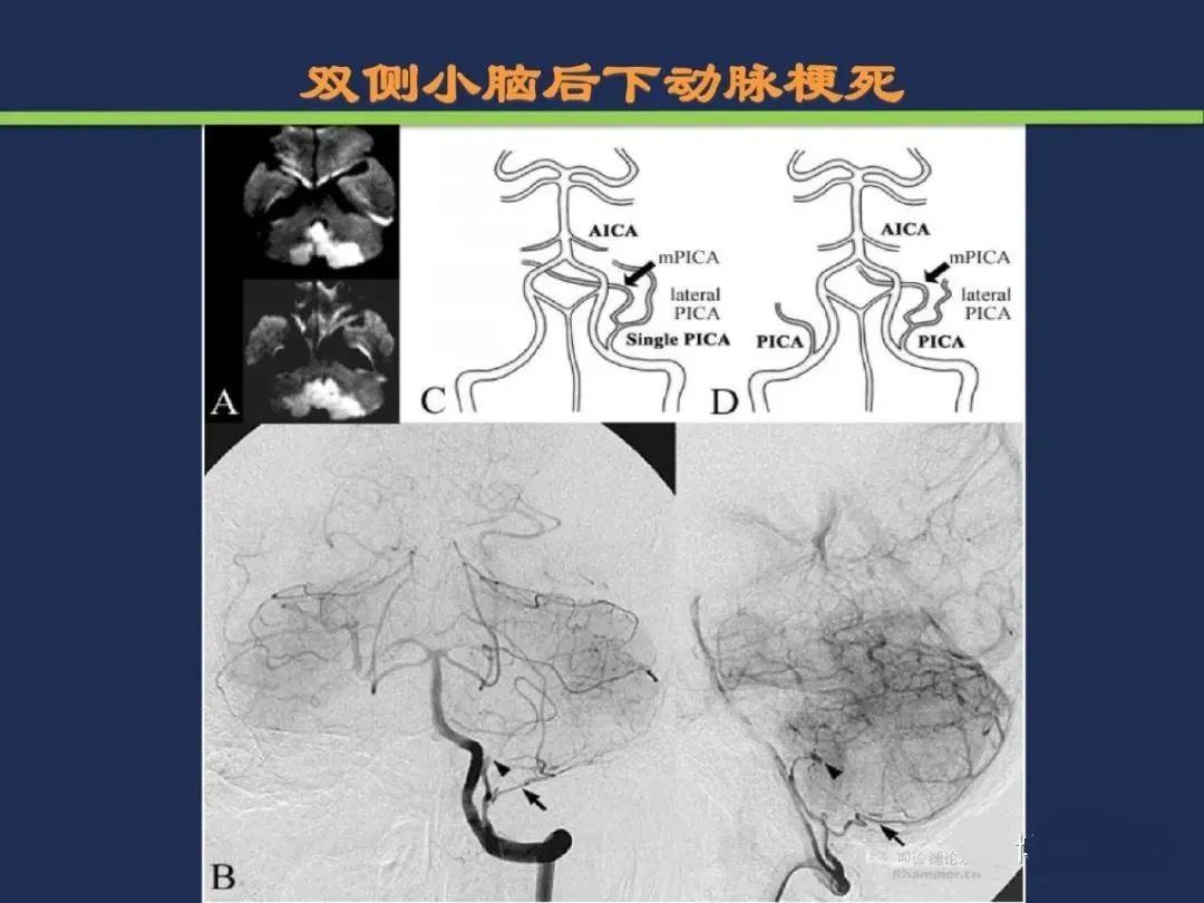 影像PPT - 从梗死部位推测责任血管:脑血管解剖-172 影像PPT - 从梗死部位推测责任血管:脑血管解剖-172