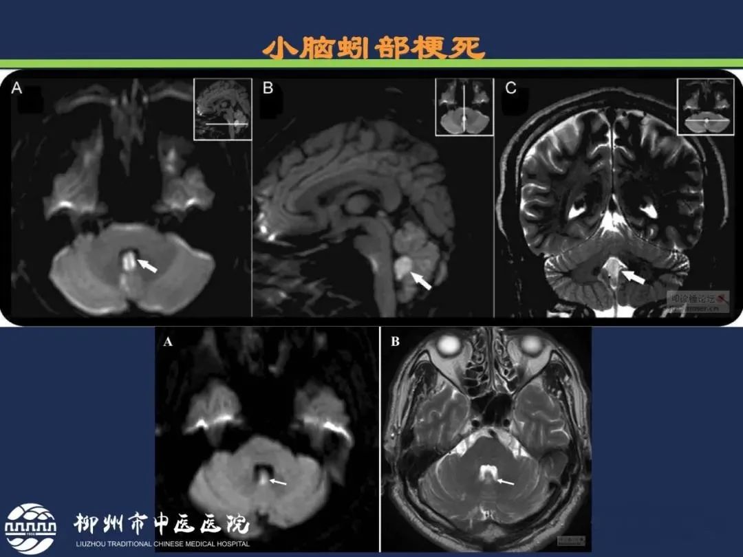 影像PPT - 从梗死部位推测责任血管:脑血管解剖-173 影像PPT - 从梗死部位推测责任血管:脑血管解剖-173