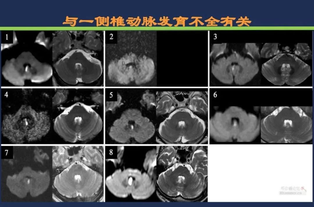 影像PPT - 从梗死部位推测责任血管:脑血管解剖-174 影像PPT - 从梗死部位推测责任血管:脑血管解剖-174
