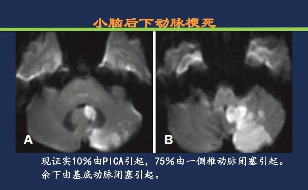影像PPT - 从梗死部位推测责任血管:脑血管解剖-175 影像PPT - 从梗死部位推测责任血管:脑血管解剖-175