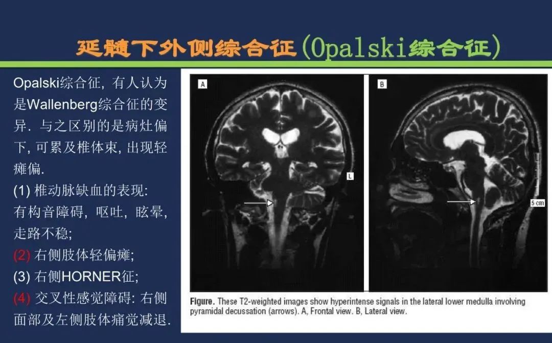 影像PPT - 从梗死部位推测责任血管:脑血管解剖-176 影像PPT - 从梗死部位推测责任血管:脑血管解剖-176