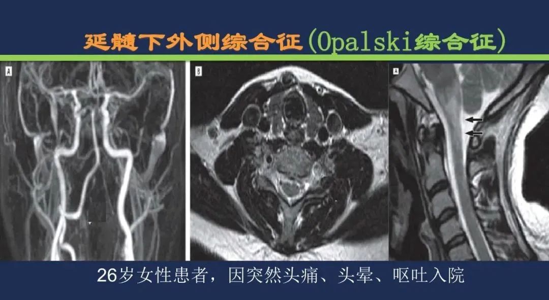影像PPT - 从梗死部位推测责任血管:脑血管解剖-177 影像PPT - 从梗死部位推测责任血管:脑血管解剖-177