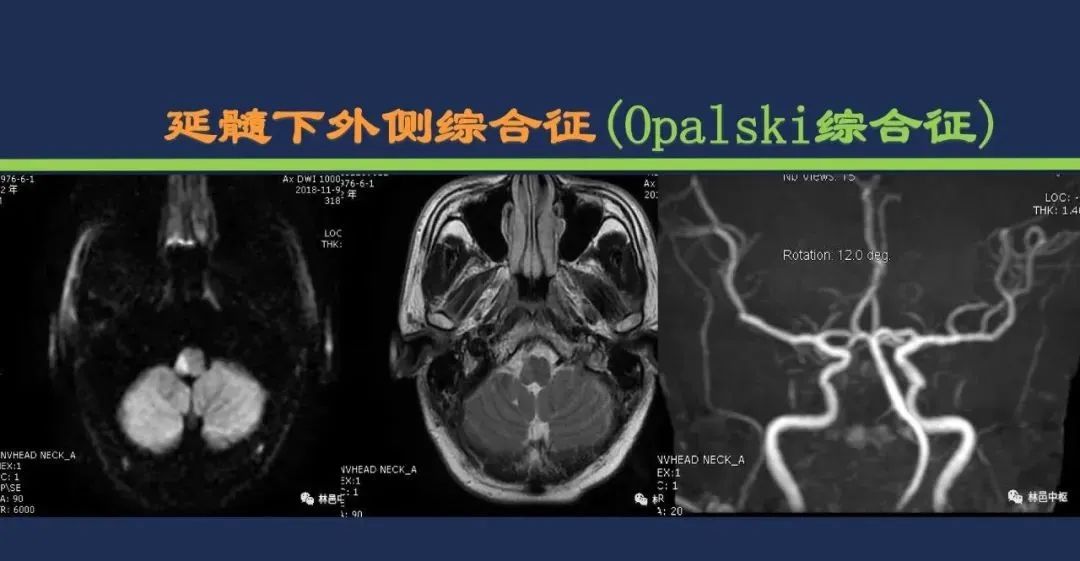 影像PPT - 从梗死部位推测责任血管:脑血管解剖-179 影像PPT - 从梗死部位推测责任血管:脑血管解剖-179