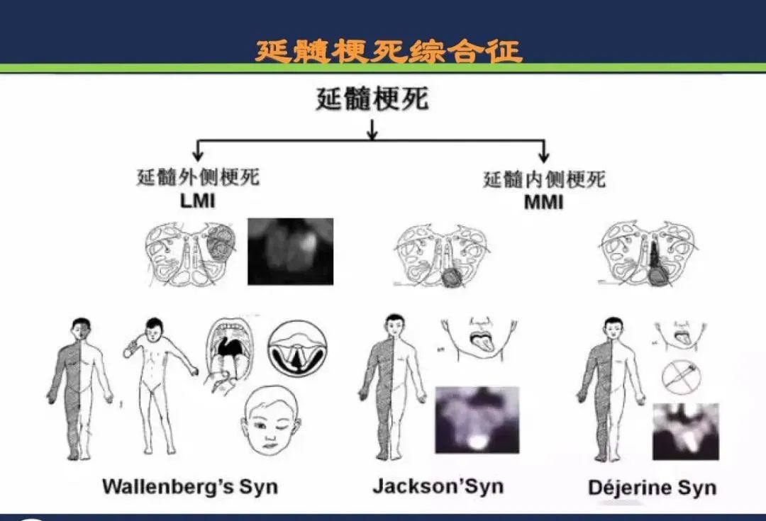 影像PPT - 从梗死部位推测责任血管:脑血管解剖-183 影像PPT - 从梗死部位推测责任血管:脑血管解剖-183
