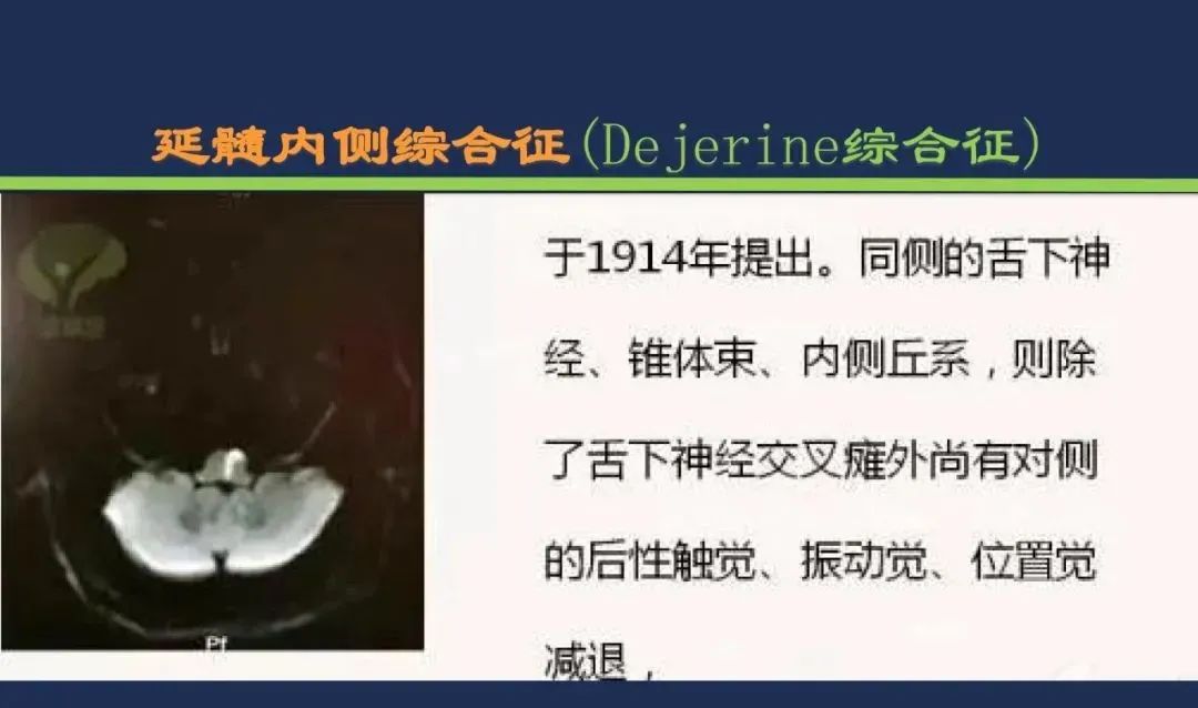 影像PPT - 从梗死部位推测责任血管:脑血管解剖-187 影像PPT - 从梗死部位推测责任血管:脑血管解剖-187