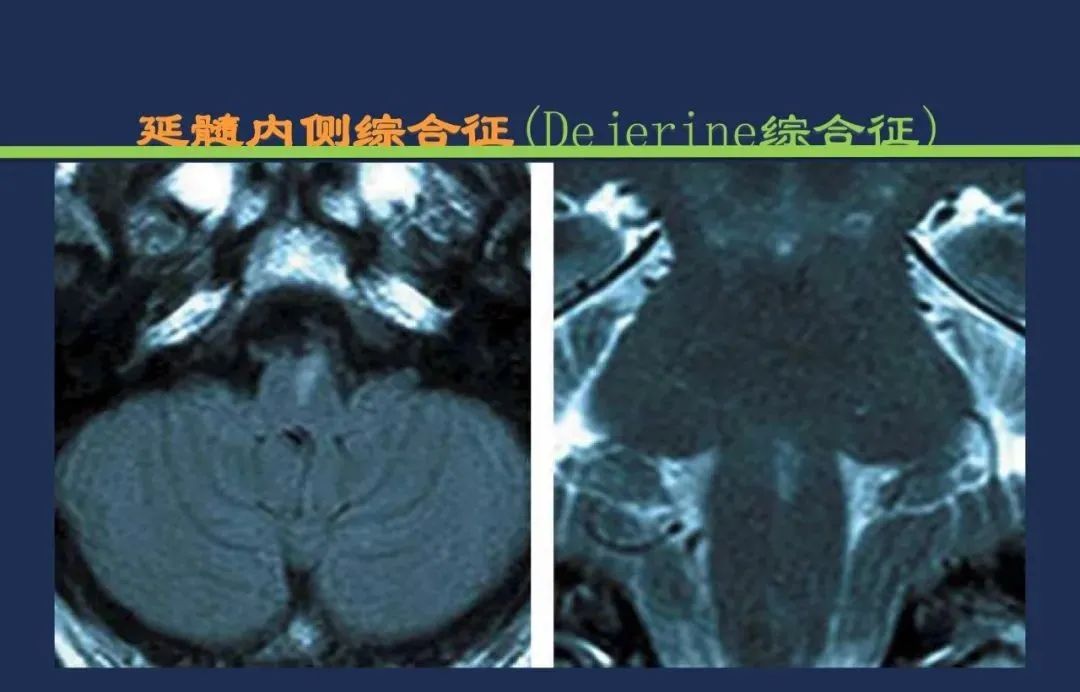 影像PPT - 从梗死部位推测责任血管:脑血管解剖-188 影像PPT - 从梗死部位推测责任血管:脑血管解剖-188