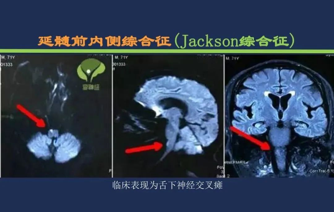 影像PPT - 从梗死部位推测责任血管:脑血管解剖-190 影像PPT - 从梗死部位推测责任血管:脑血管解剖-190