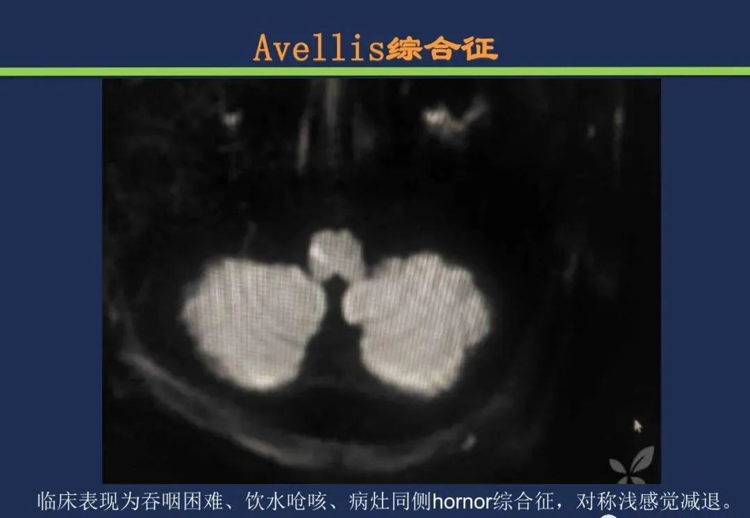 影像PPT - 从梗死部位推测责任血管:脑血管解剖-191 影像PPT - 从梗死部位推测责任血管:脑血管解剖-191