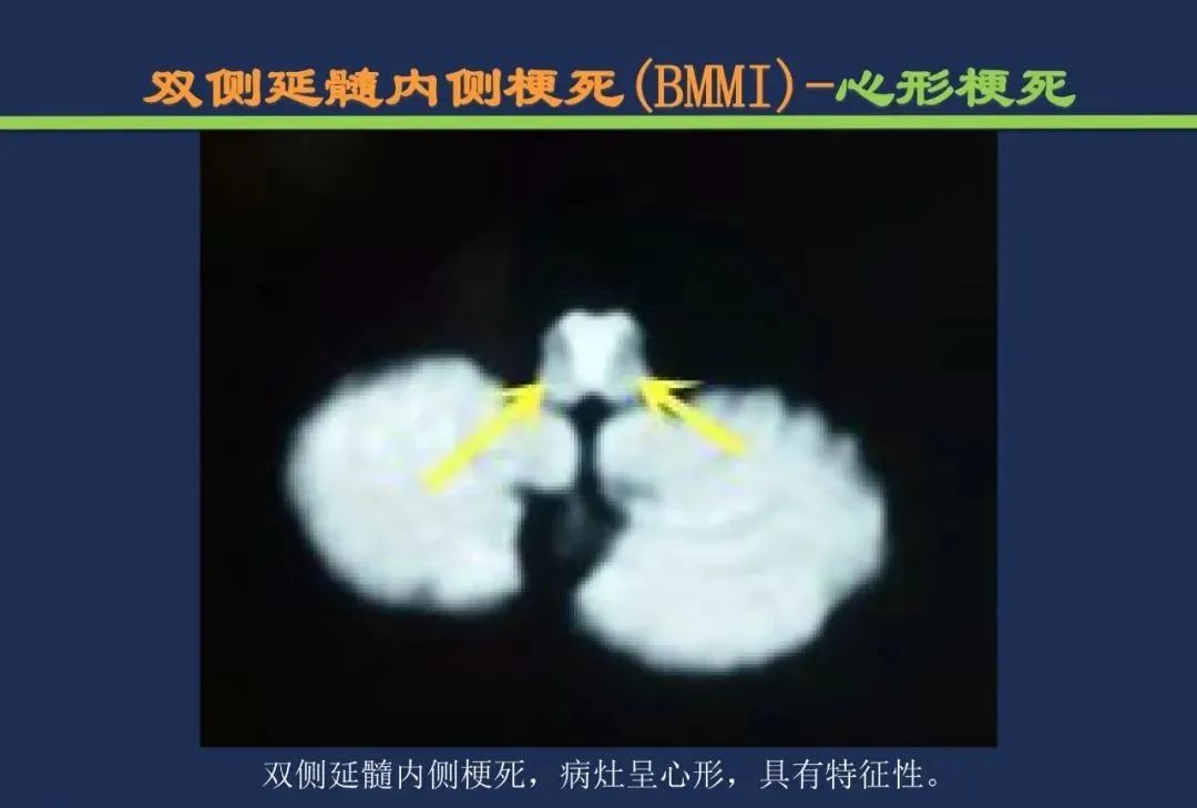 影像PPT - 从梗死部位推测责任血管:脑血管解剖-192 影像PPT - 从梗死部位推测责任血管:脑血管解剖-192