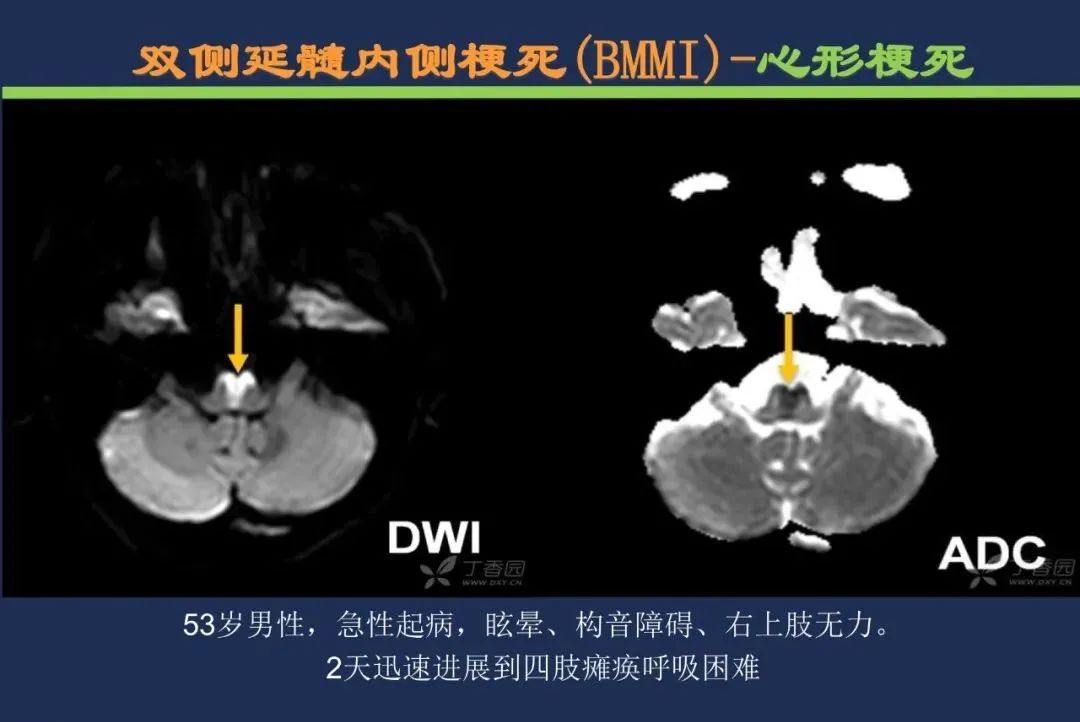 影像PPT - 从梗死部位推测责任血管:脑血管解剖-193 影像PPT - 从梗死部位推测责任血管:脑血管解剖-193