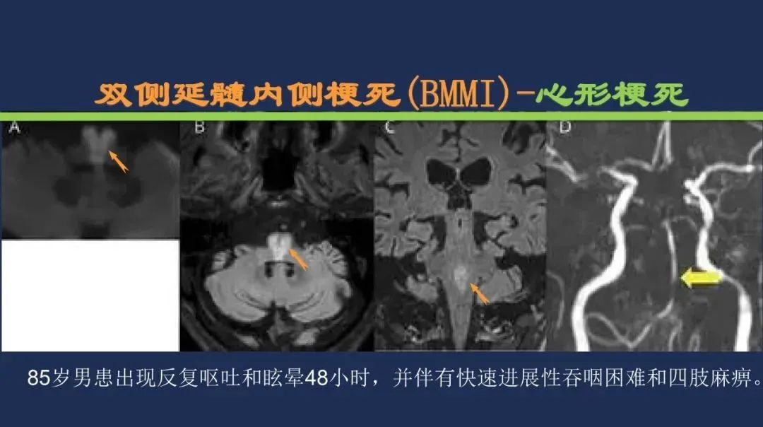 影像PPT - 从梗死部位推测责任血管:脑血管解剖-194 影像PPT - 从梗死部位推测责任血管:脑血管解剖-194